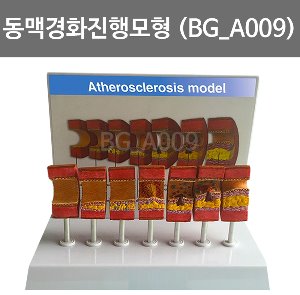 동맥경화 진행모형 BG-A009