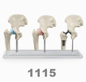 [독일Zimmer]  인공고관절 고관절 모형 1115 (임플란트,3단계,독일정품) Hip-Implant-Model 고관절임플란트/MI