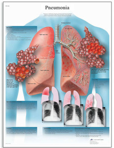 [3B] 폐렴차트(감염된 폐방사선 사진) VR1326UU(비코팅) Pneumonia Chart (Size 50x67cm)
