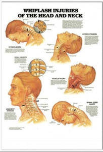 3D해부도(벽걸이)/9989/머리와 목차트 (반복성 긴장장애)/Whiplash Injuries of The Head and Neck/ Size 54cmx74cm