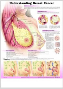 3D해부도(벽걸이)/9758B/유방암의 이해,유방암차트/Understanding Breast Cancer/ Size 54cmx74cm