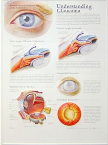 3D해부도(벽걸이)/9286/녹내장 차트/Understang Glaucoma/ Size 54cmx74cm