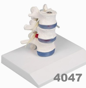 [독일Zimmer] 요추모형 4047 (디스크탈출모형,실제규격,분리관찰) Lumbar vertebrae with prolapsed inter vertebral discs with stand.