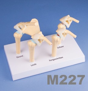 [독일Zimmer] 어깨관절 퇴행성 4단계모형 M227 (1/2실제규격) 4-Stage Osteoarthritis (OA) Shoulder.