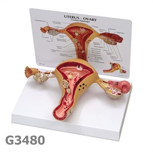 [GPI] 자궁병리모형 G348,3480 자궁질환모형 자궁모형