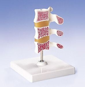 [3B] 척추모형 A78 (골다공증,Deluxe Osteoporosis Model)
