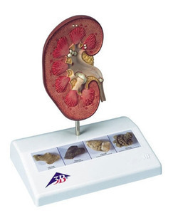 [3B] 신장결석 모형 K29 (Kidney Stone Model)