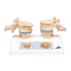 [3B] 골다공증모형 A95 (Osteoporosis Model)