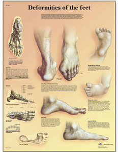 [3B] 발기형차트 VR1185L(코팅),VR1185UU(비코팅) Deformities of the Feet Chart  (Size 50x67cm)