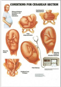 3D해부도(벽걸이)/9985/제왕절개차트,산부인과차트/Conditions for Cesarean Section/ Size 54cmx74cm